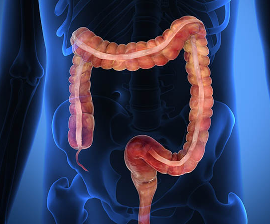 Cancer colorrectal